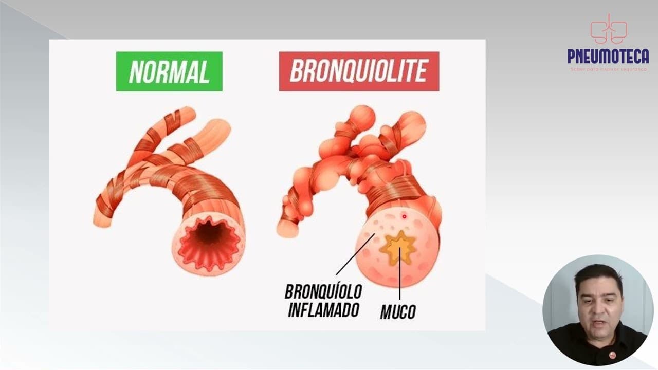 Bronquiolite viral aguda: Aula gratuita para público geral